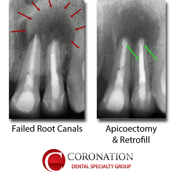 Failed root canal, with infection around the roots
